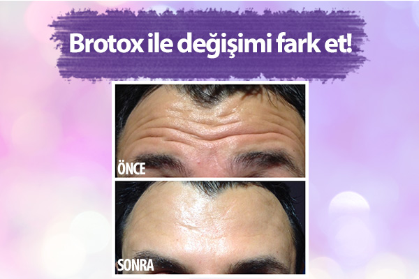 “BROTOX “: Erkekler arasında “Botox” trendi